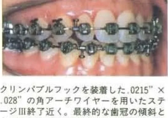 【Tip-Edgeの変遷:過去の症例から学ぶ】Class III・前歯部開咬(抜歯部位選定・顎外力不使用)にみる、旧仕様ブラケットでの治療方針決定プロセス(1995年 社内報より)